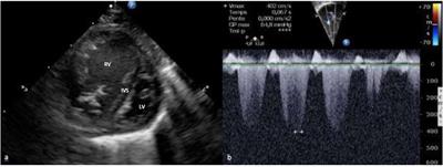 Case Report: Persistent Pulmonary Hypertension of the Newborn and Narrowing of the Ductus Arteriosus After Topical Use of Non-Steroidal Anti-Inflammatory During Pregnancy